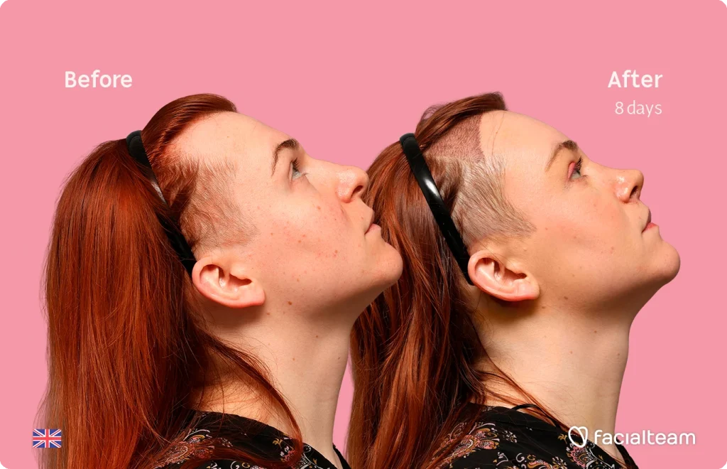 Side-by-side profile photos labeled 'Before' and 'After 8 days' showing facial improvement on a pink background (Facialteam logo in corner).