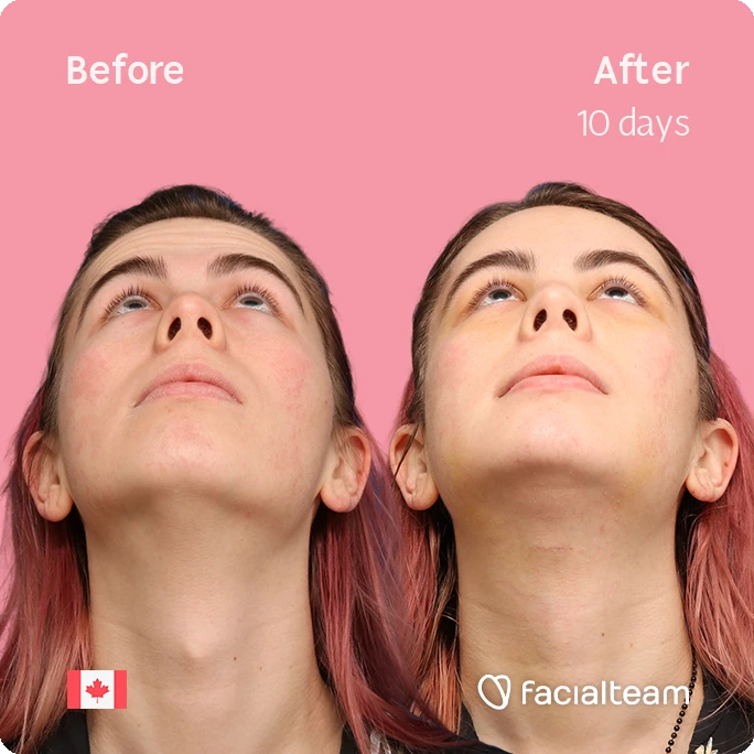 Before and after comparison: young woman's face tilted upward on pink background; left labeled Before, right labeled After 10 days of treatment (Facialteam).