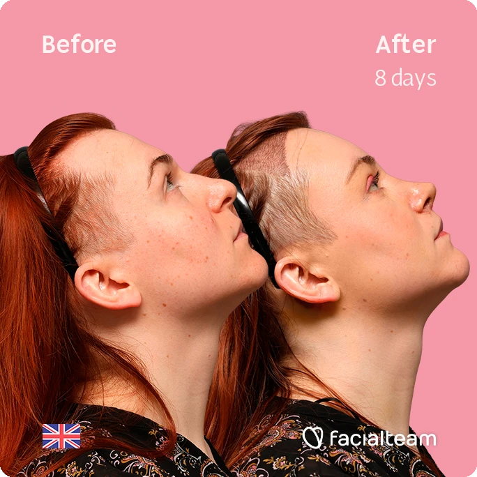 Side-by-side profile photos of a woman before (left) and after 8 days, with a pink background and a Facialteam logo in the bottom right.